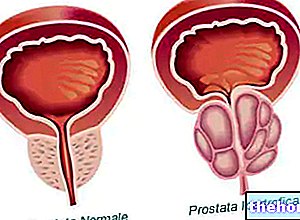 Rakovina prostaty