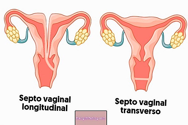 Qu'est-ce que la cloison vaginale et comment la traiter