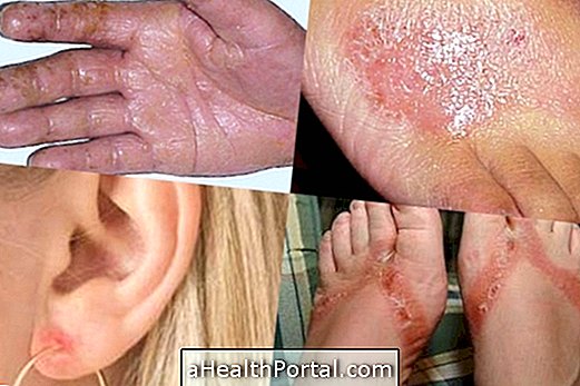 Quelle est la dermatite de contact et comment traiter