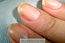 Dermatite de contact irritant