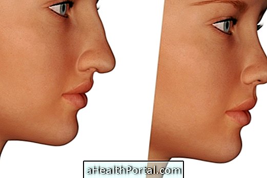 La chirurgie au nez peut améliorer l'estime de soi et la respiration