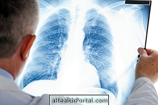 Qu'est-ce que le SRAS: syndrome respiratoire aigu