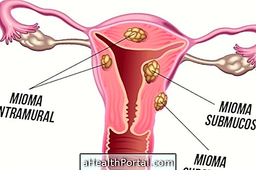 Remèdes pour Myoma dans l'utérus