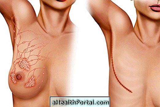 5 types principaux de mastectomie et comment ils sont fabriqués