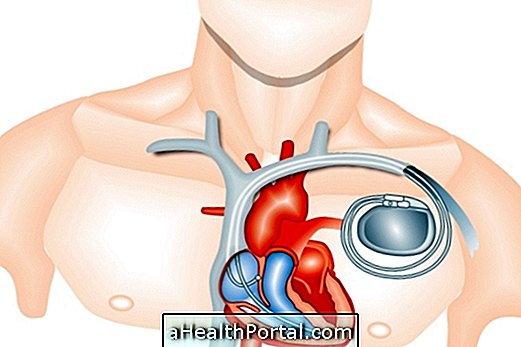 Stimulateur cardiaque: de quoi s'agit-il et des soins après le placement