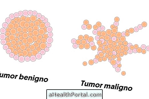 Quelle est la différence entre tumeur, cancer et néoplasme
