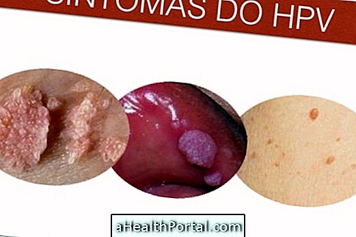 La pommade Barbatimão pourrait guérir le VPH