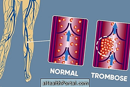 Comment identifier la thrombose et quoi faire pour éviter