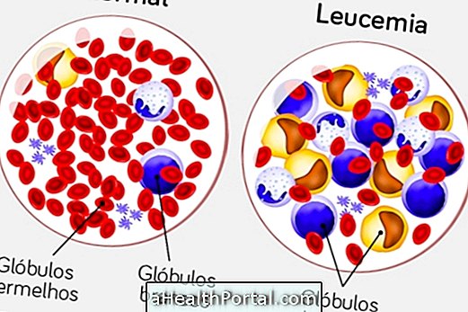 Leucémie lymphoïde: qu'est-ce que c'est, symptômes principaux et comment traiter