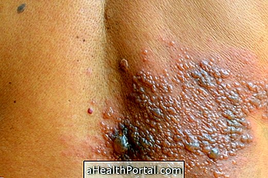Qu'est-ce que et comment traiter une dermatite herpétiforme