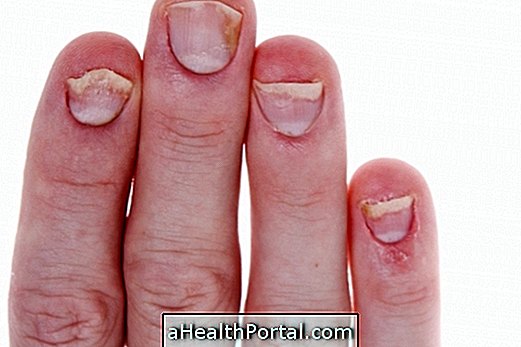 Traitement du psoriasis dans les ongles