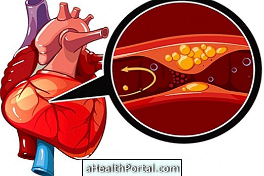 Comment identifier et traiter l'ischémie cardiaque