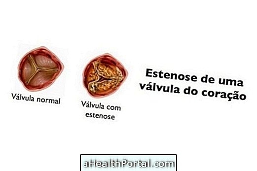 Sténose aortique: qu'est-ce que c'est, symptômes et traitement
