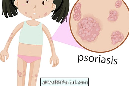 Psoriasis en gouttes: symptômes et traitement