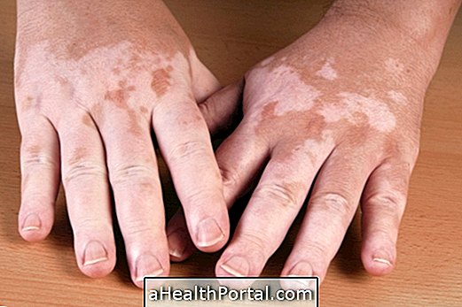 Que peut causer le vitiligo et comment le traiter?