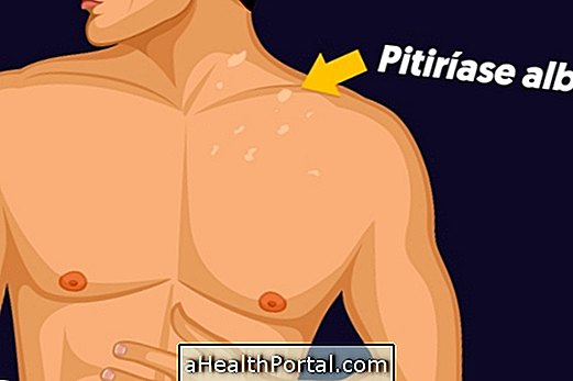 Qu'est-ce que Pityriasis alba et comment traiter