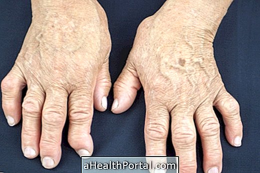 L'arthrite psoriasique: qu'est-ce que c'est, symptômes et traitement