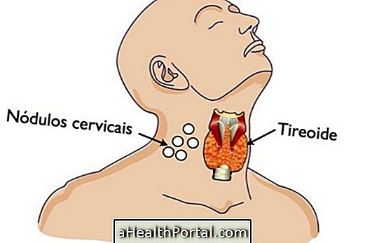 Chirurgie thyroïdienne: types, comment procéder et récupération
