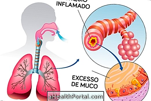 Tout sur la bronchite: types, causes, symptômes et traitement