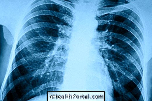 Comment la pneumonie est contagieuse et comment la prévenir