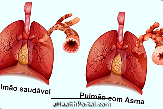 Comprendre l'asthme