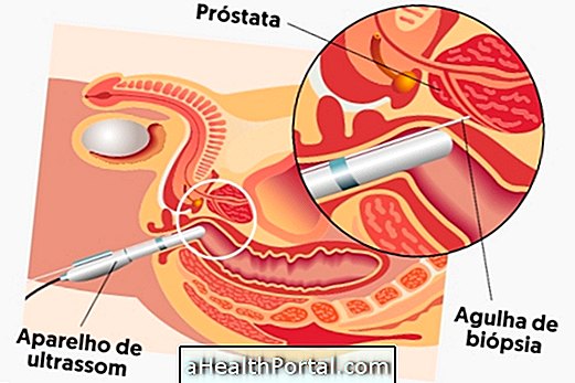 Tout sur la biopsie de la prostate