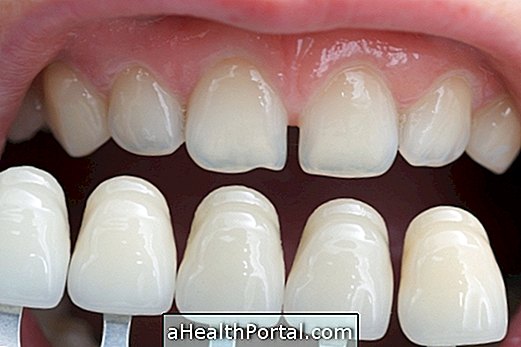 Lentilles de contact dentaires: à quoi ça sert et quand les mettre