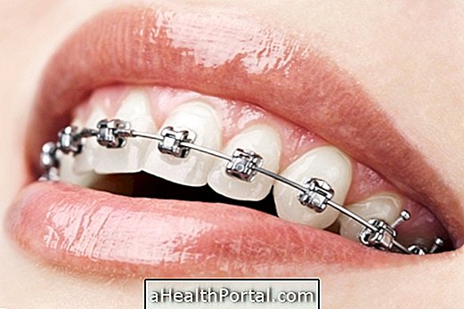 Appareil orthodontique: connaître les principaux types