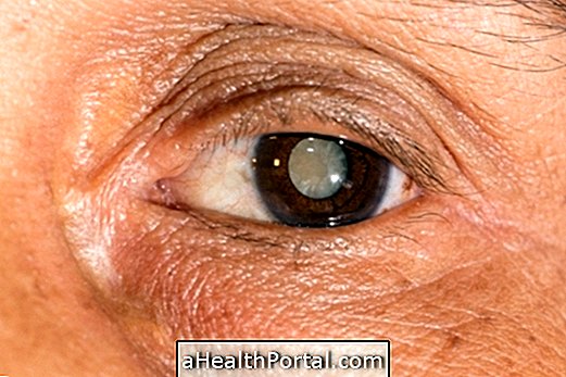 Traitement de la cataracte: chirurgie ou collyre