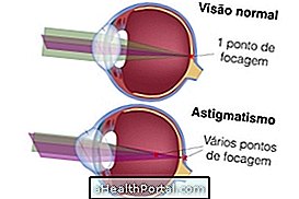 Symptômes de l'astigmatisme et traitement