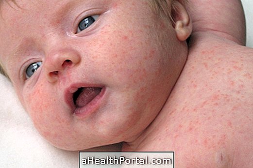 Allergie dans la peau de bébé: symptômes et quoi faire