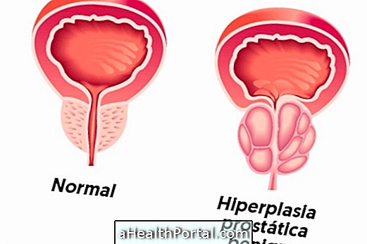 Qu'est-ce que l'hyperplasie bénigne de la prostate et comment la traiter?