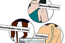 Symptômes de neurofibromatose