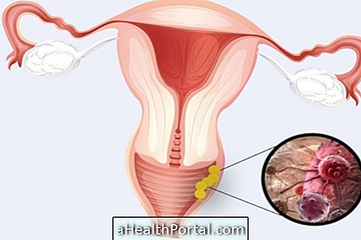 Cancer vaginal: Comment identifier et qui est plus à risque