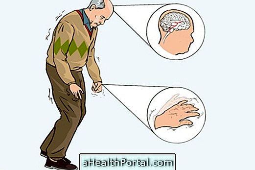 Principaux signes et symptômes de la maladie de Parkinson