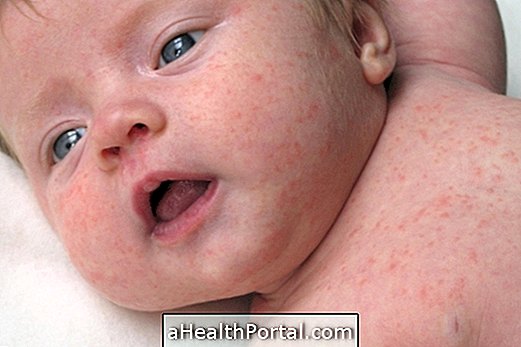 Signes et symptômes de l'allergie alimentaire chez le bébé