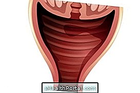 Quels sont les symptômes de la candidose vaginale et comment la traiter