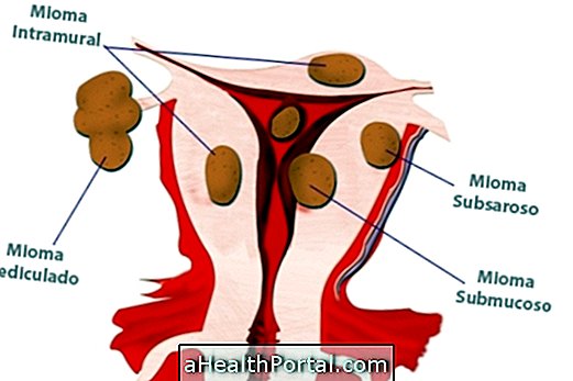 Types de fibromes utérins